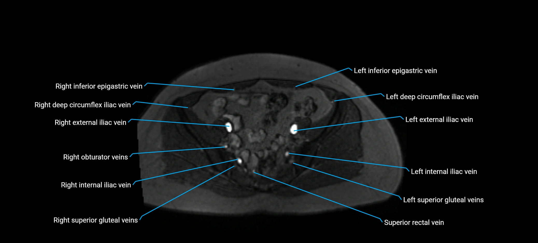 MRV abdomen pelvis & lower limb axial cross sectional anatomy labelled MRI image 147 (1).webp